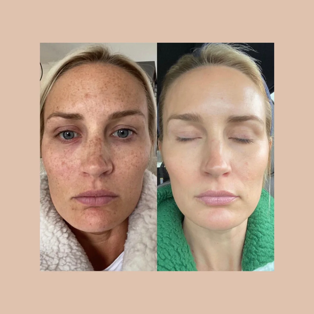 Leke Tedavisi | Sk Beauty Touche